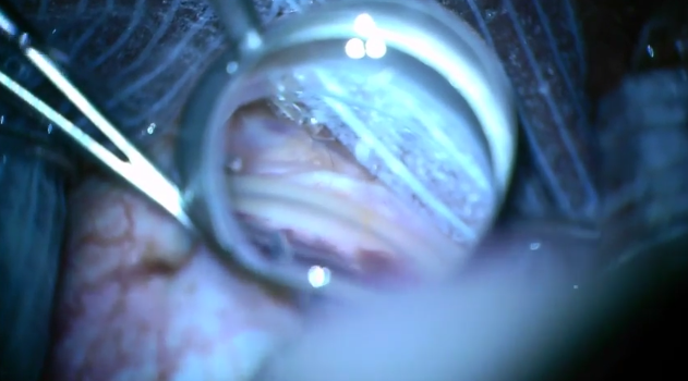 Trabectome and Ab Interno Canaloplasty