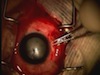 Intraocular Foreign Body Removal