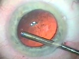 Capsular Cleaning to Remove Lens Epithelial Cells