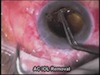 Penetrating Keratoplasty and Scleral Fixation IOL