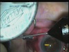 Surgeon-Bent Vitrectomy and Endo-Diathermy: A Novel Technique