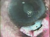 Suprachoroidal Hemorrhage Crash Landing