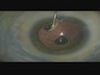 Pearls for Avoiding Vitreous Traction and Unplanned Vitrectomy Surgery