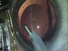 Viscoelastic Removal V4c 