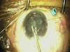 Traumatic Cataract with AMO Signature and 25G Vitrectomy