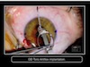 Combination of CXL and ARTIFLEX Toric Phakic IOL for the Management of Early Keratoconic Cases 
