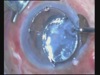 Double Trouble-Double IOL - 2 cases