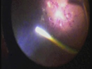 Twenty-five-gauge Vitrectomy for Proliferative Diabetic Retinopathy