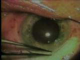 Circular anterior capsulotomy
