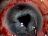 That Clear Thing that Covers the Retina