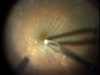 Techniques in Vitreoretinal Surgery: ILM Peeling in Diabetics