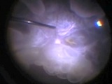 Bubble Wrap Retinopathy
