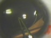 Pediatric Cataract