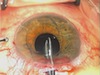 Posterior Chamber IOL Exchange at 4 Months for High Ametropic Error