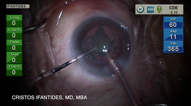 Routine Cataract Surgery