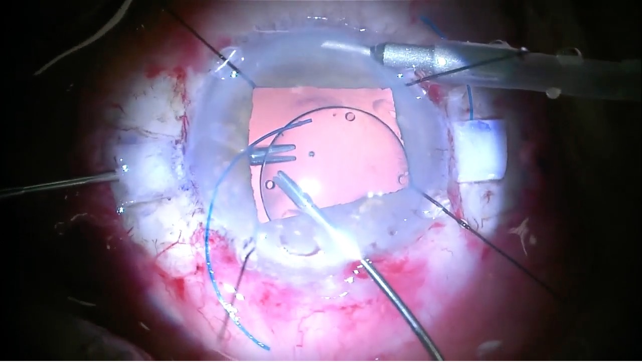 Glued IOL Technique to Correct Subluxated IOL in a Prior Iris Sutured IOL