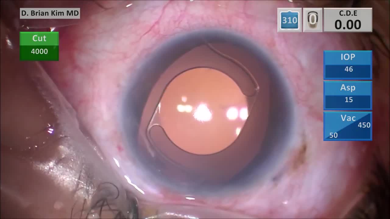 My Pearls and Modifications of the Yamane Scleral Haptic Fixation ...