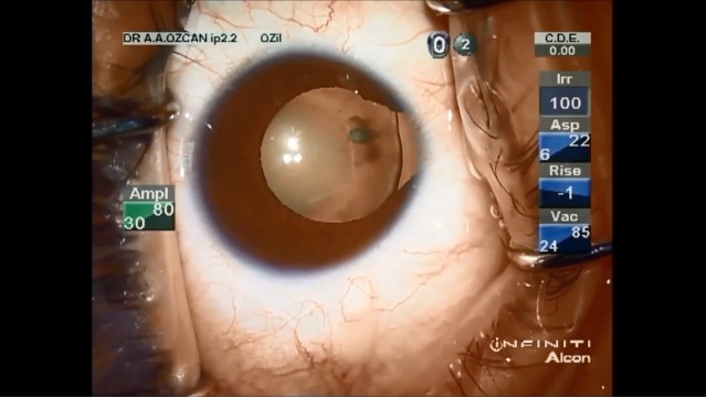 Lens Coloboma