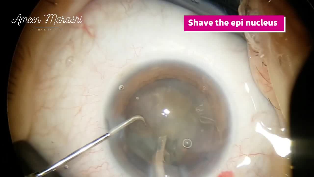Phaco Horizontal Chop
