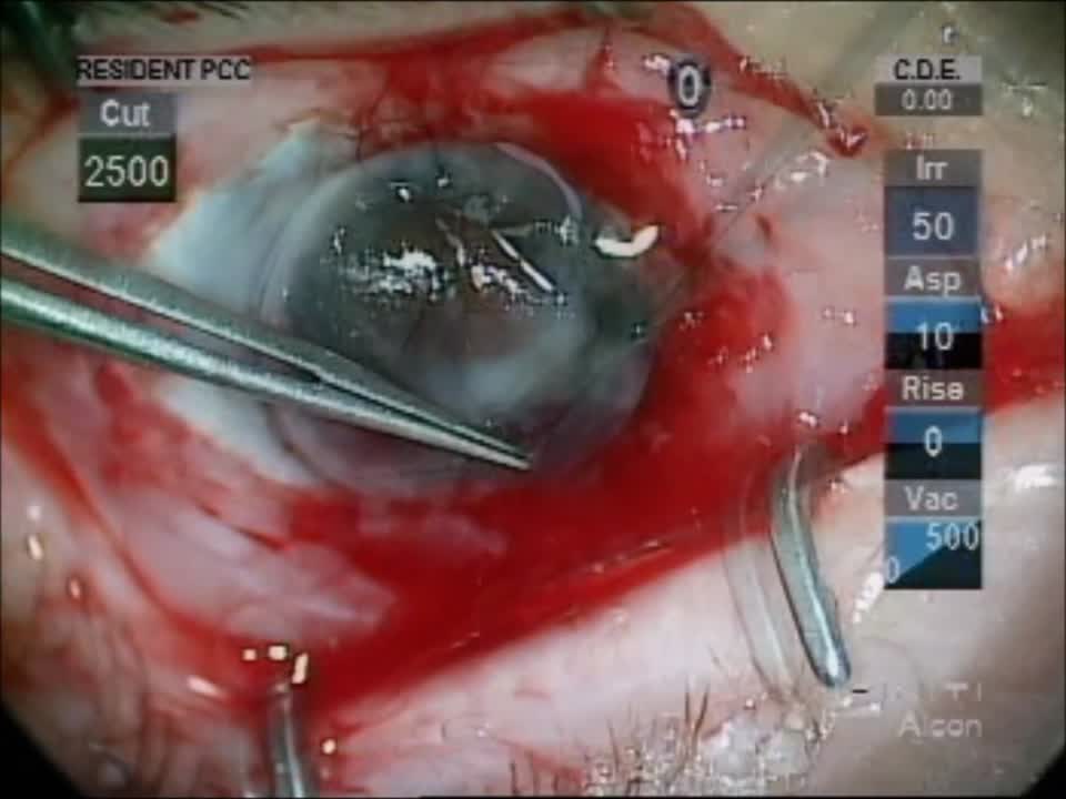 Anterior Segment Reconstruction in a Patient With Extruded Boston KPro and Melted Cornea With Exposed PC-IOL