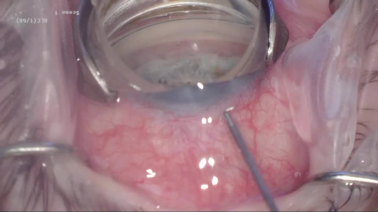 Placement of an iStent