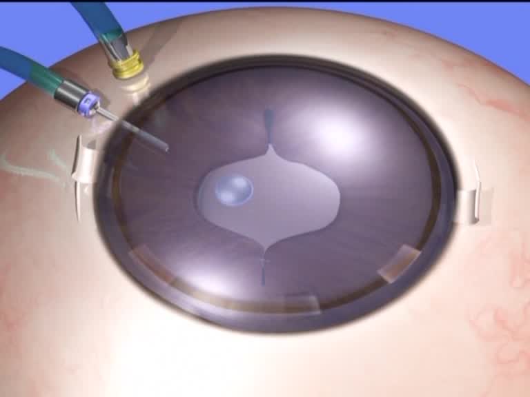 Double Infusion Cannula Technique (DICT)