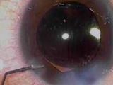 The Dry Vitrectomy