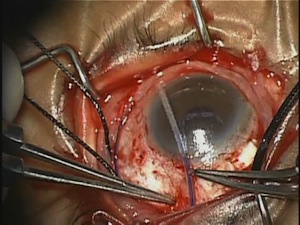 Molteno III Tube 245mm Posterior Chamber Placement with a 14% C3F8 Gas Bubble