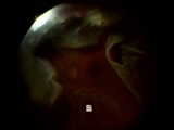 Small Gauge Infusion into Choroid