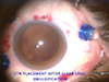 Surgical Removal of Hard Subfoveal Exudates in Diabetic Eye
