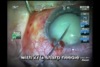 Hypermature White Intumescent Cataract