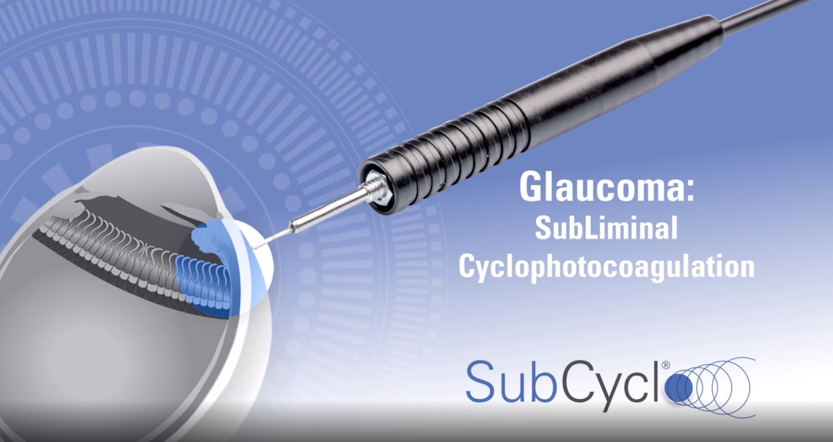 Glaucoma: When Cyclophotocoagulation Meets SubLiminal&trade; Technology