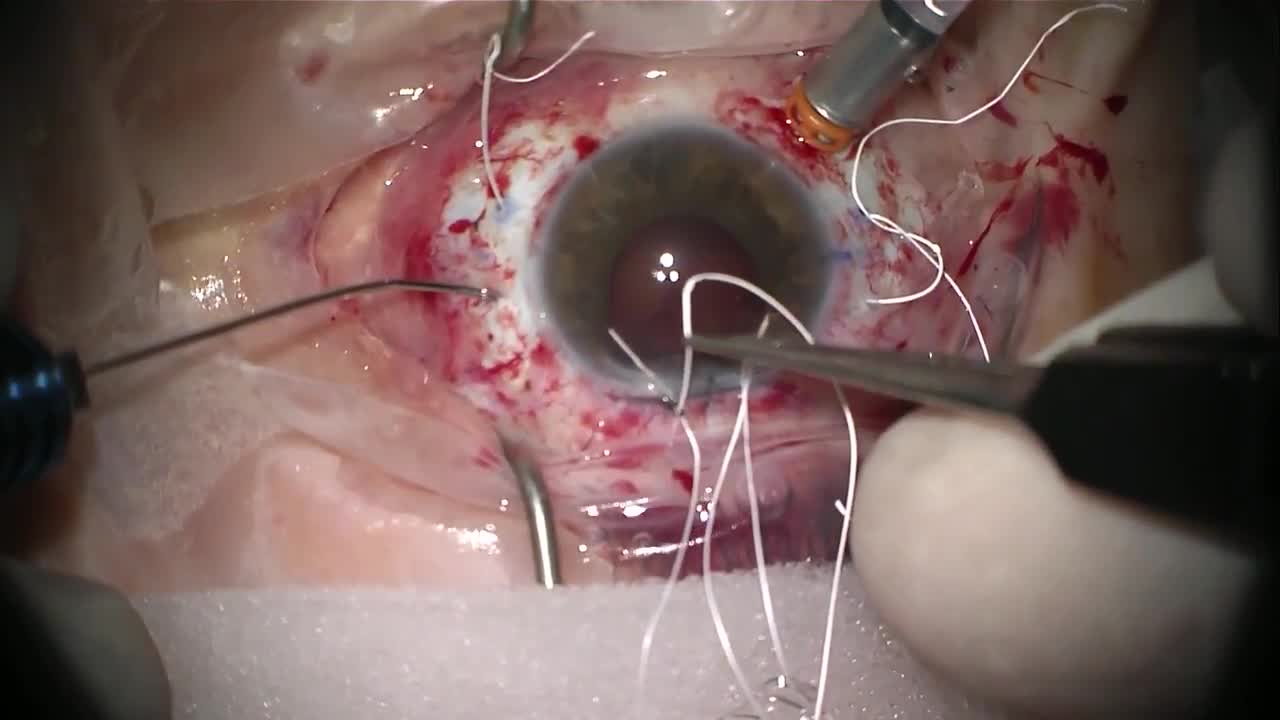 Scleral Fixation of an IOL with a Suture Retriever