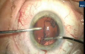 Primary Posterior Laser-Assisted Capsulotomy