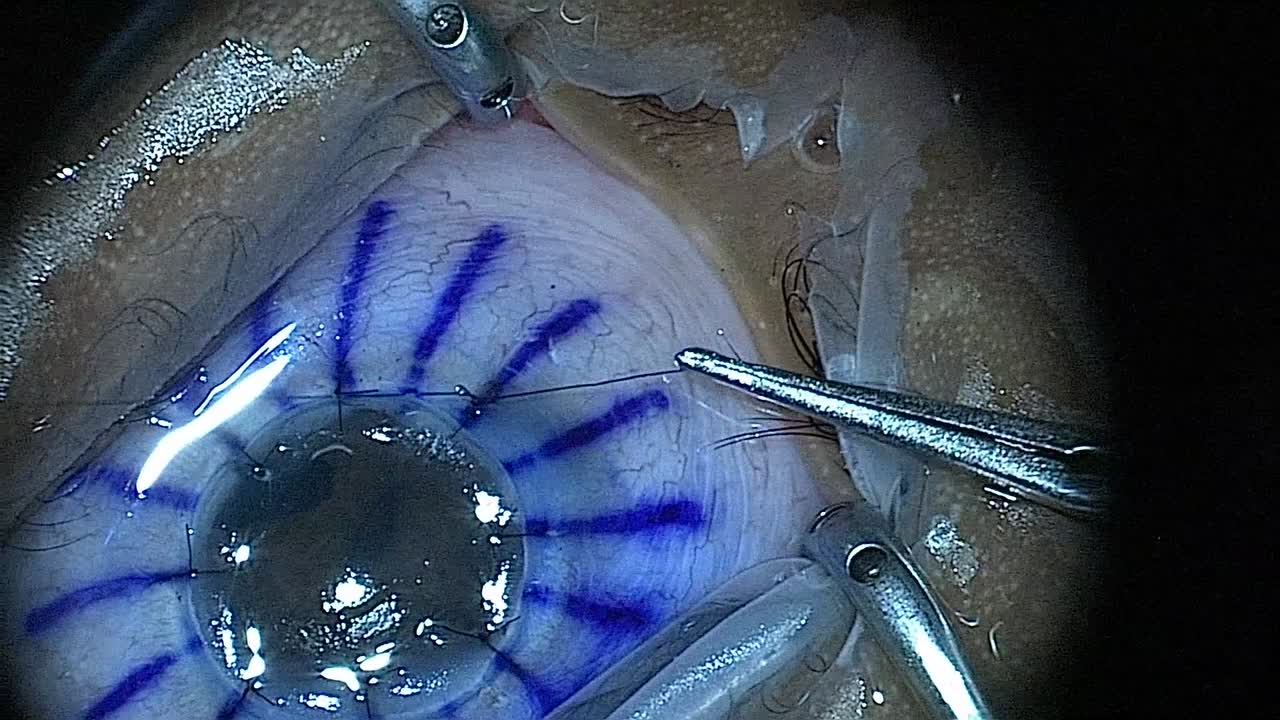 Penetrating Keratoplasty for Sclerocornea in an Infant