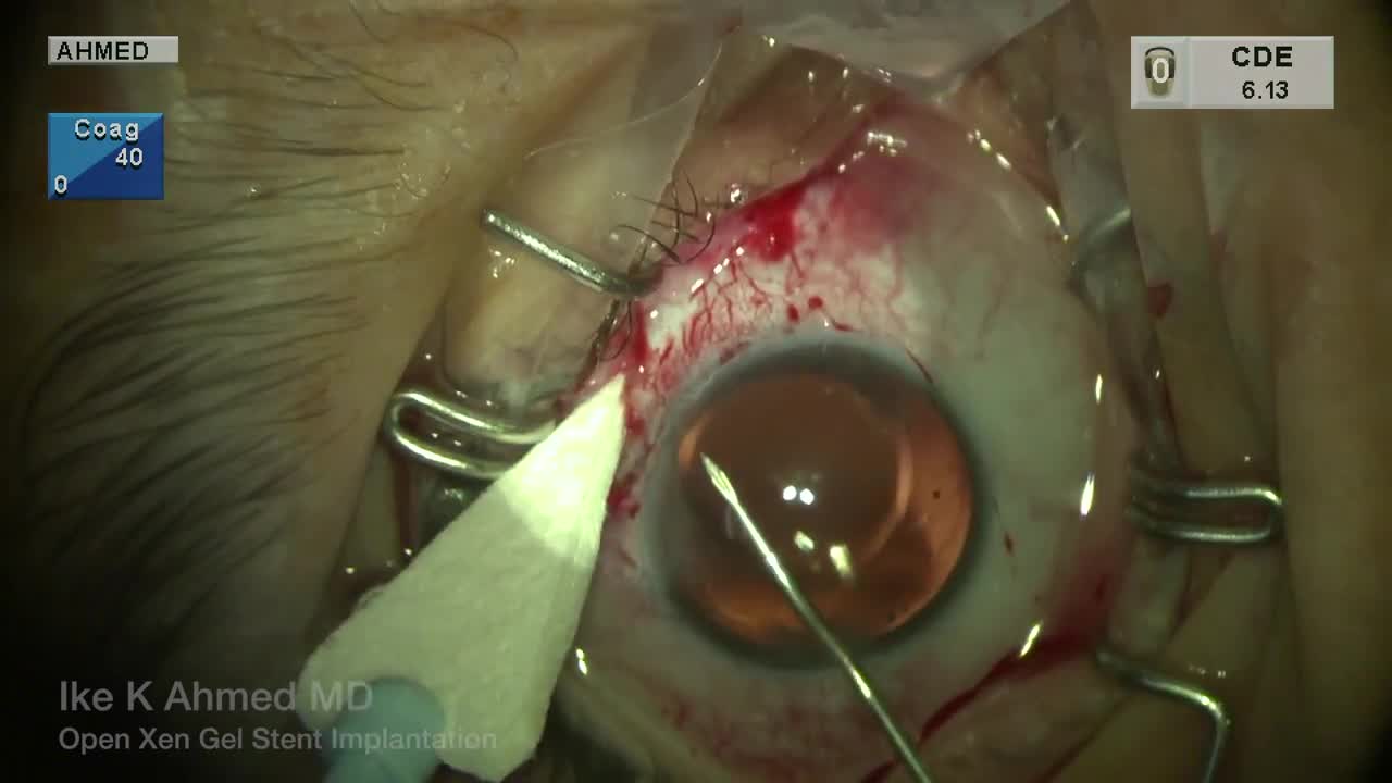 Open Xen Implantation