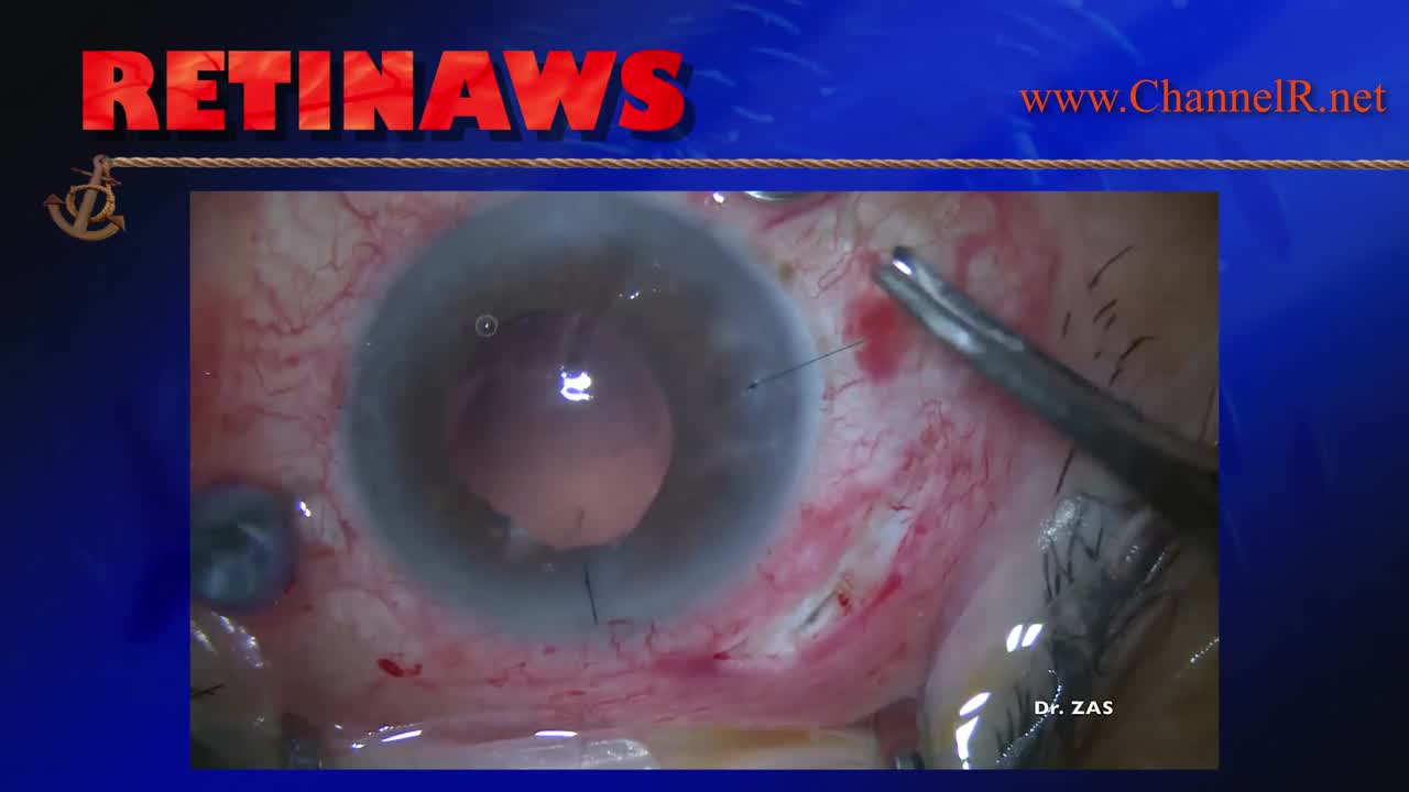 Cataract