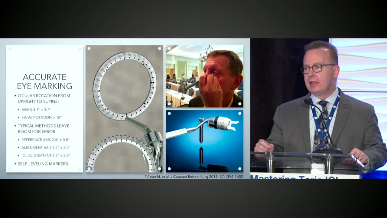 Toric IOL Marking Techniques