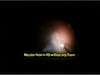 ILM Peeling in Macular Hole with Retinal Detachment