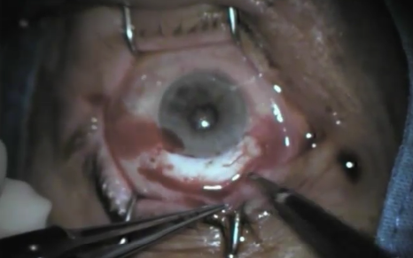 Cataract Surgery in Eye with Long-Standing Uveitis