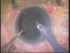 Cystotme Assisted Prechop Technique
