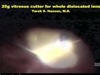 Small-Gauge Vitrectomy for Dislocated Lens Fragments