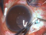 Repositioning a Luxated Lens
