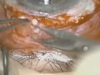 Subconjunctival Silicone Oil After Sutureless Virectomy