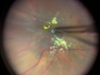 Vitrectomy Combined With Suprachoroidal Steroid Delivery - Part 2