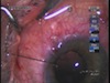 Traumatic Zonular Dehiscence - A Case for Cionni Ring