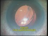 Subluxated IOL to Glued IOL in an Eye Surgeon