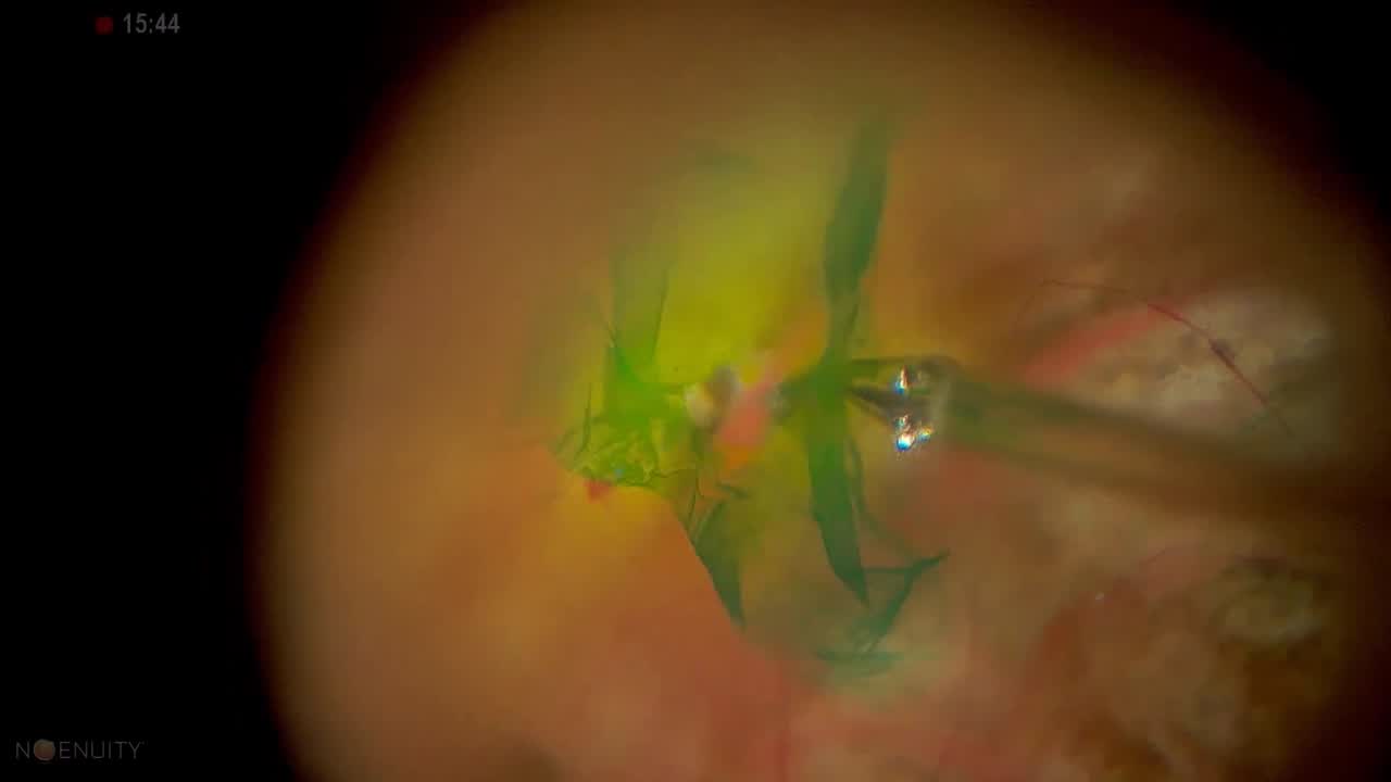 ILM Peeling