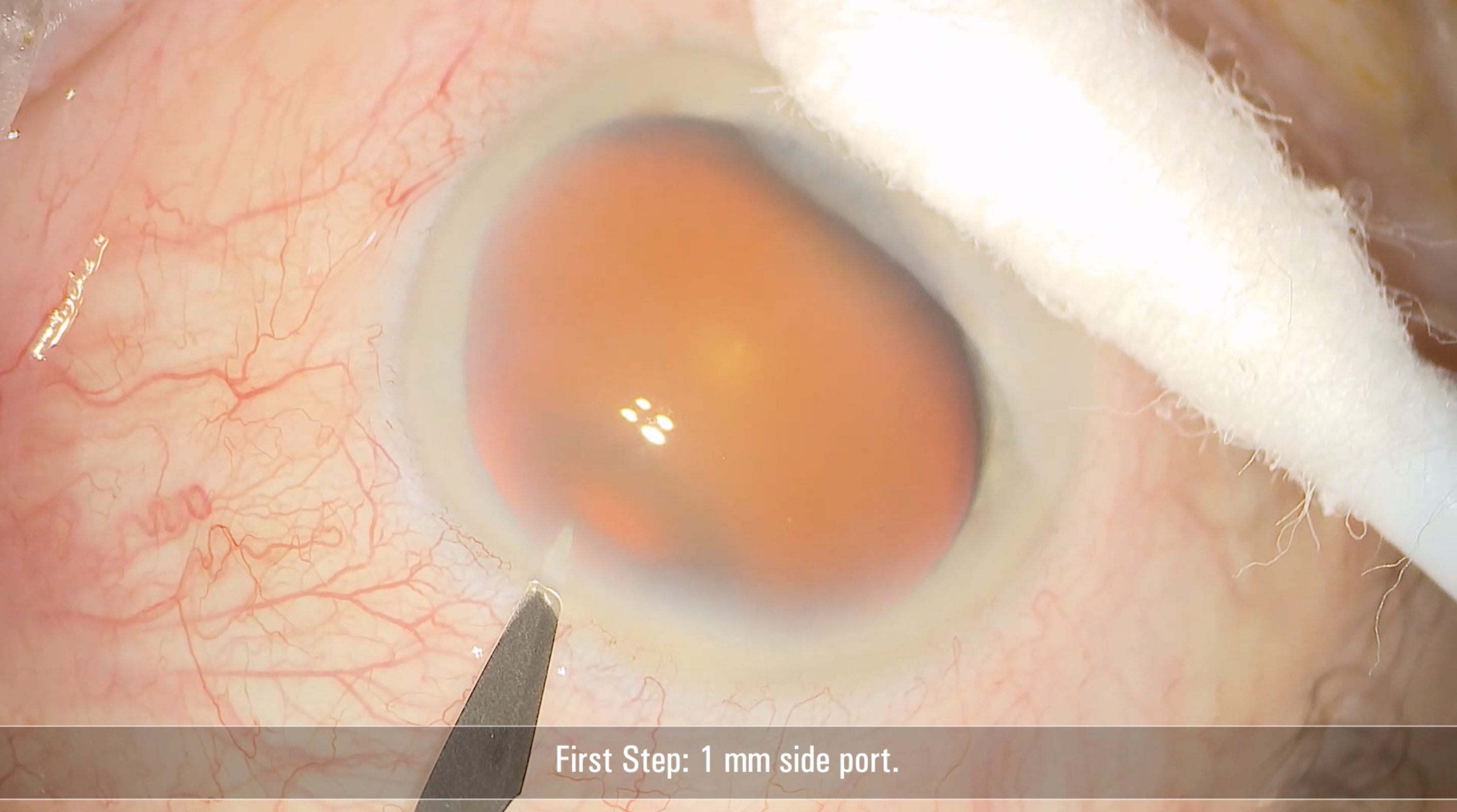 Cataract Surgery with the Proveo 8 Microscope
