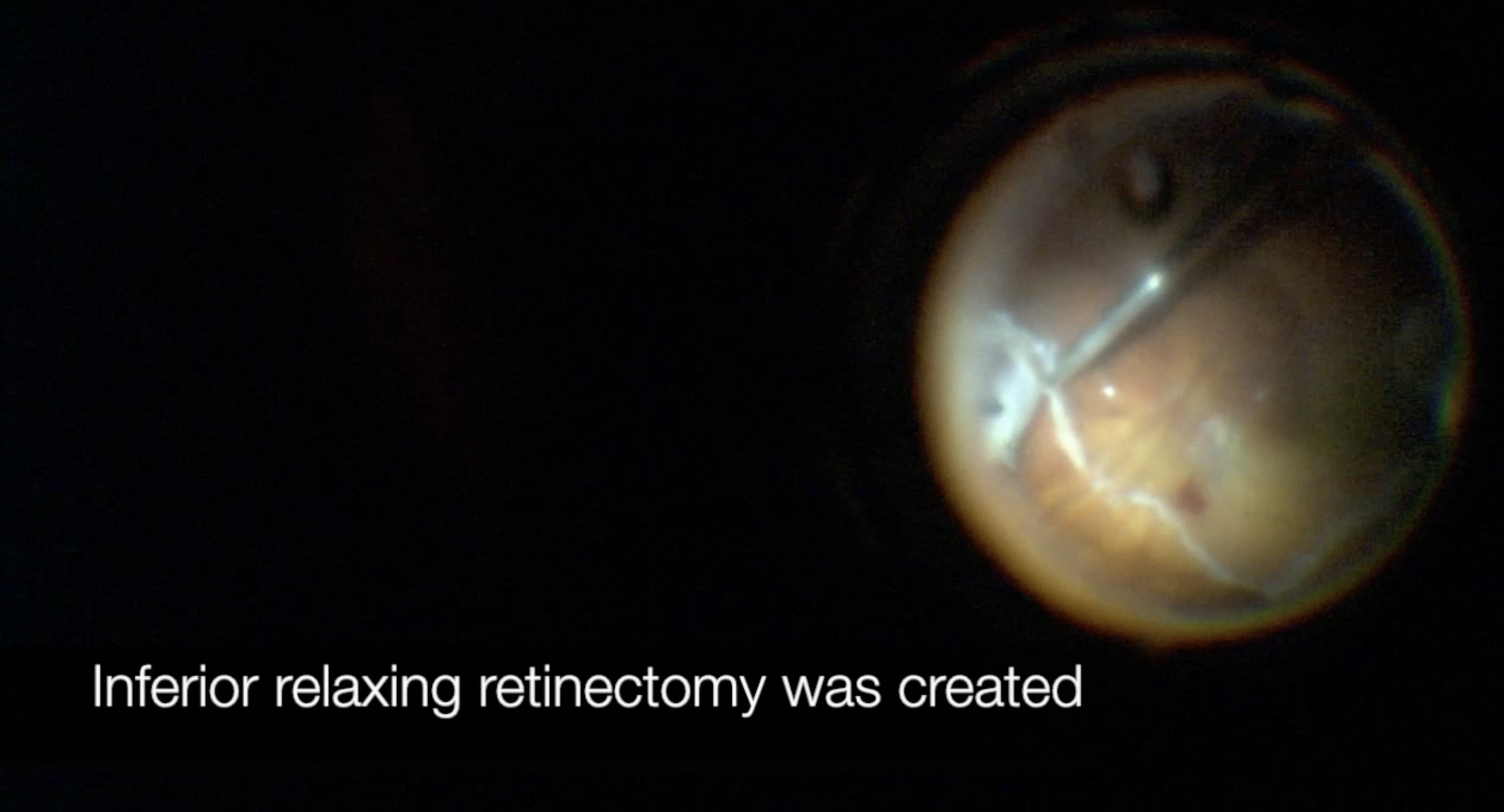 Retinal Detachment Repair in an Eye with a Permanent Keratoprosthesis and Glaucoma Drainage Tube